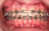 Fixed Braces